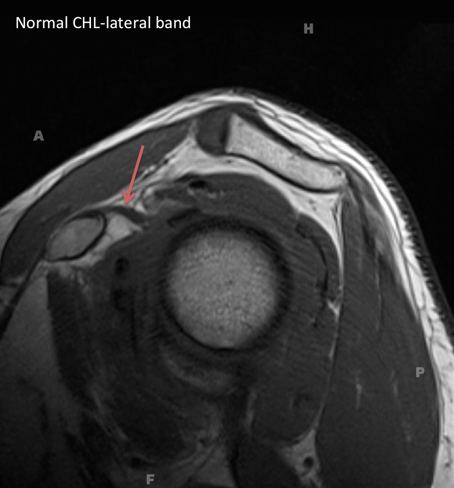 adhesive capsulitis